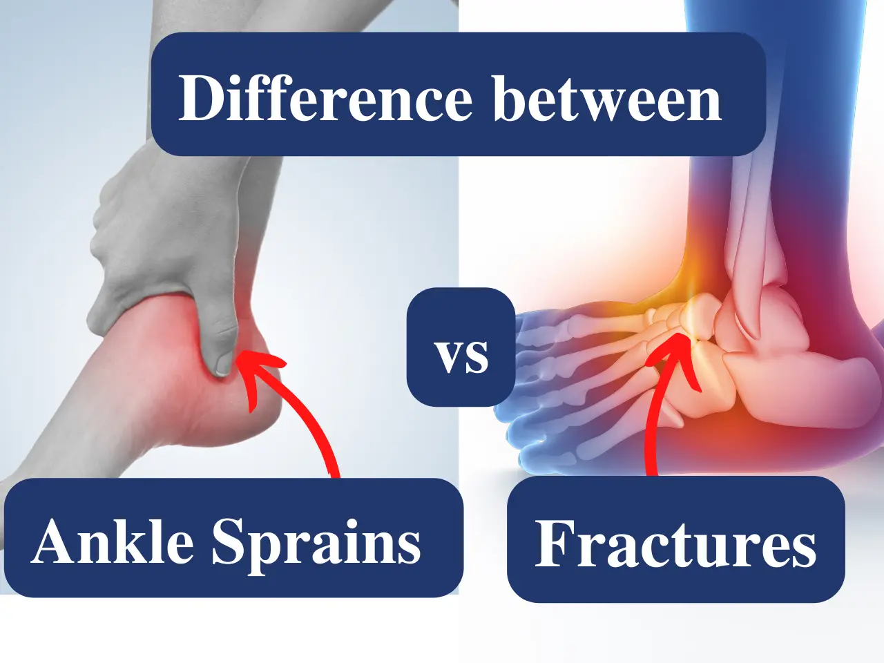 Difference between Ankle Sprains vs Fractures