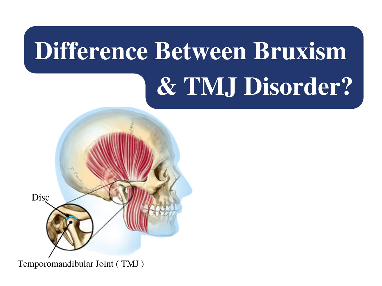 Difference Between Bruxism and TMJ Disorder?